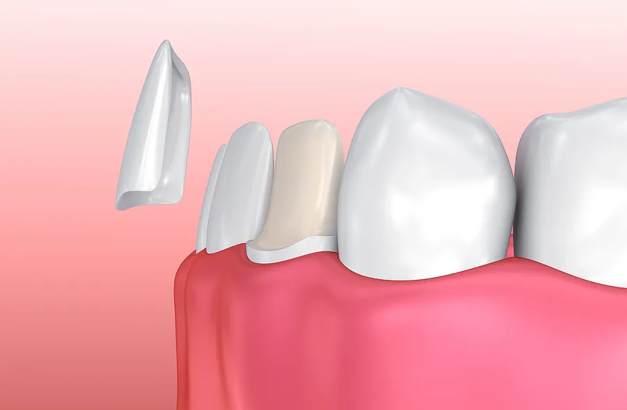 What Different Cosmetic Issues Can Porcelain Veneers Correct?