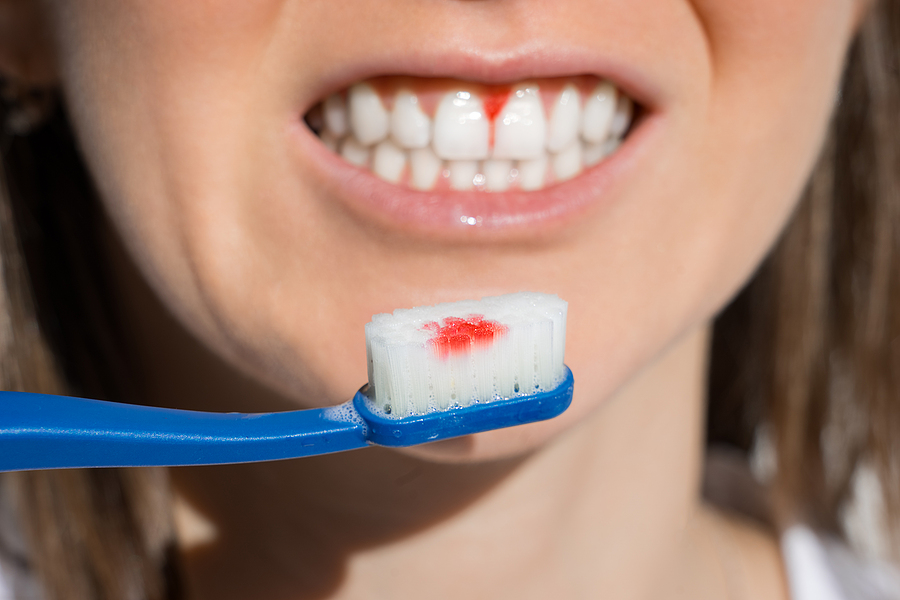 4 Ways to Stop Gum Disease in Its Tracks