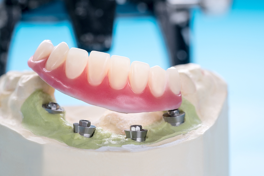 A Dentist in Lakeway Debunks 4 Popular Dental Implant Myths