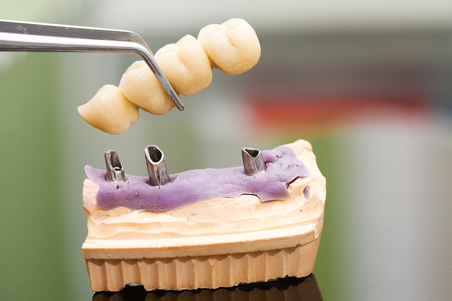 Shopping for Dental Implants in Lakeway? Here’s a Helpful Guide!